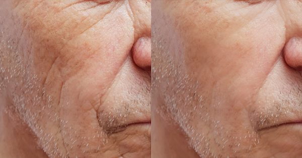 Peptide Therapy Elderly Man Before After